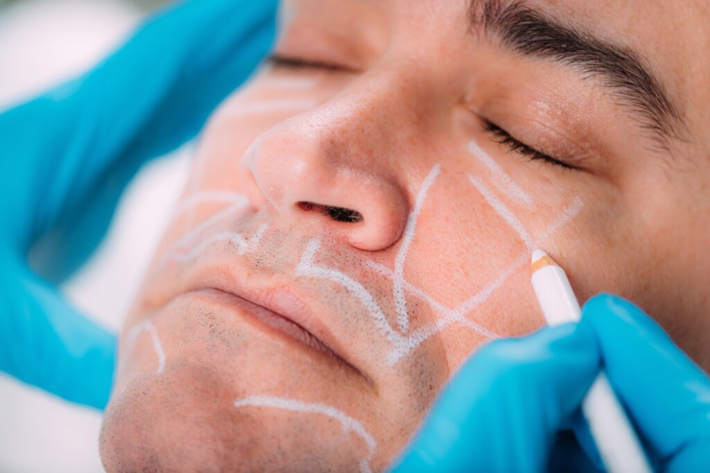 Dermal Fillers for Men. Marking Man’s Face Before Dermal Filler Treatment